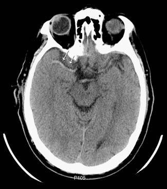 neurologic fig 1 hyperdense MCA sign.pdf