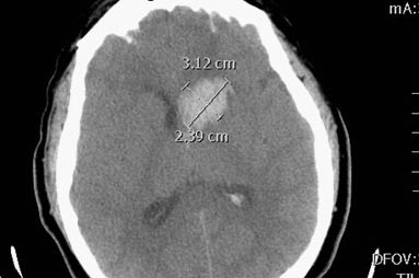 neurologic fig4 nonenhanced CT intracerebral hemorrhage.pdf