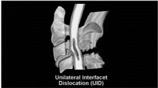 EMR061812 fig 16 unilateral facet dislocation.jpg