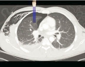 Figure 2. US pneumothorax ACEP.jpg