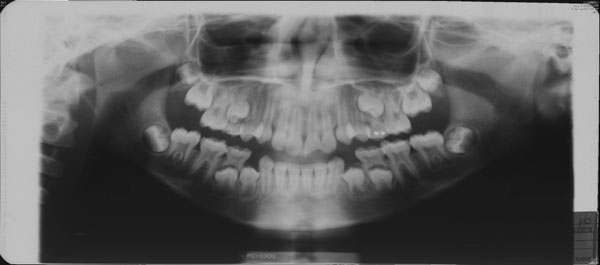 mandibular fracture.jpg