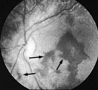 PDMR0712 fig 5 retinal hemorrhages.jpg