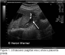 placenta previa.jpg