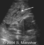 placental abruption with retroplacental clot image a.jpg