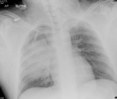 pulmonary contusion 2.pdf