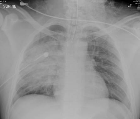 pulmonary contusion 3.pdf