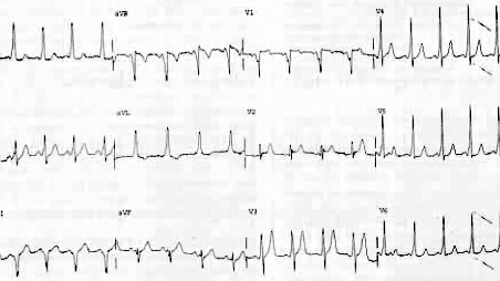 disorders cardiac pediatric patient svt management delta waves ahc note