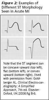 A: Follow-up electrocardiogram showing a 0.5 mm convex ST-segment