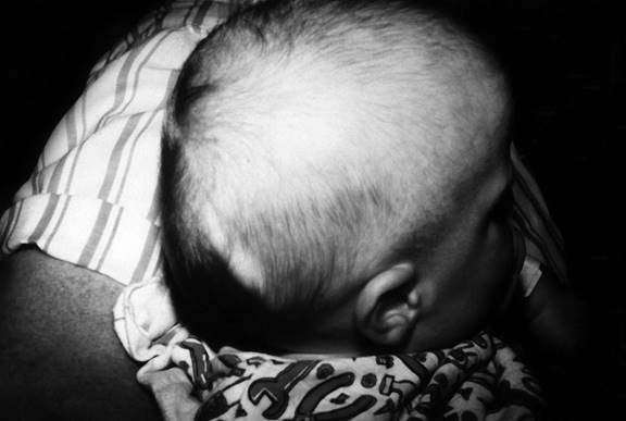 Ventriculoperitoneal Shunt in an Infant