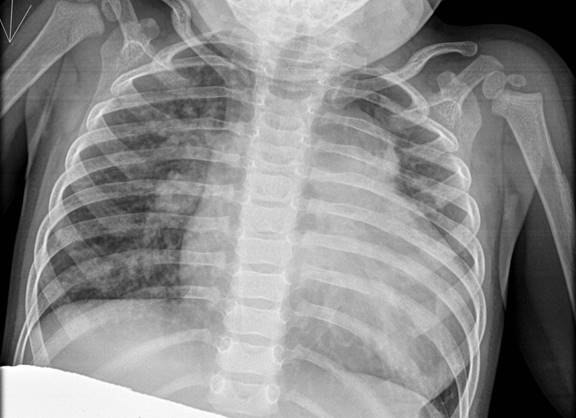 Cardiomegaly and pulmonary venous congestion