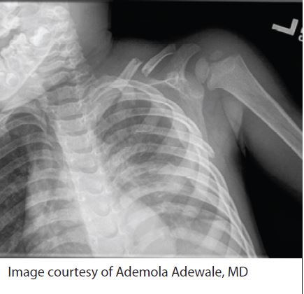 Figure 2. Clavicle Fracture