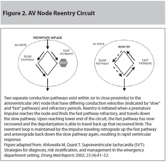 Figure 2 AV Node Reentry Circuit.JPG