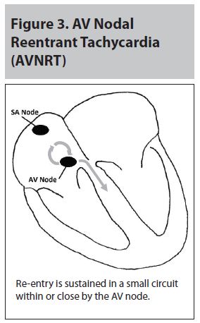 Figure 3 AV Nodal Reentrant Tachycardia (AVNRT).JPG