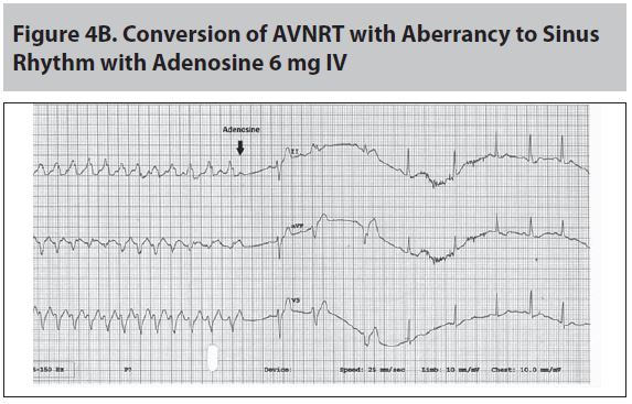 Figure 4B Conversion of AVNRT with Aberrancy to Sinus Rhythm with Adenosine 6 mg 4.JPG