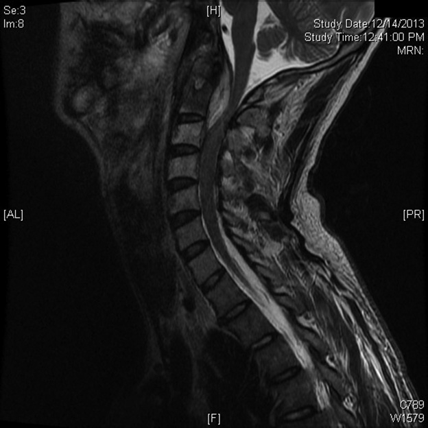 cervical epidural abscess