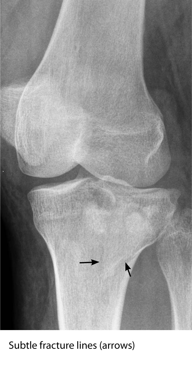 lateral tibial plateau fracture AP