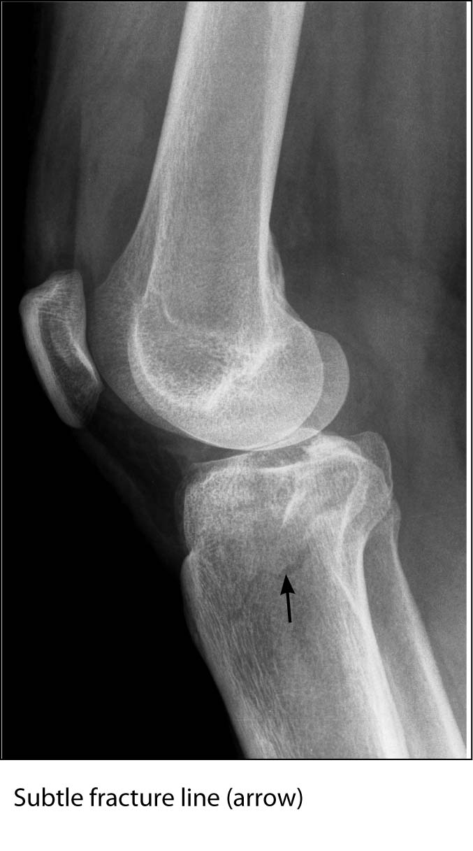 lateral tibial plateau fracture