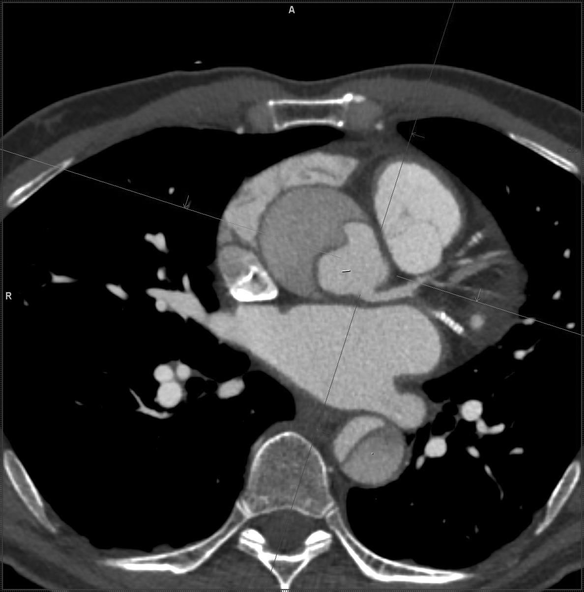 aortic dissection CT
