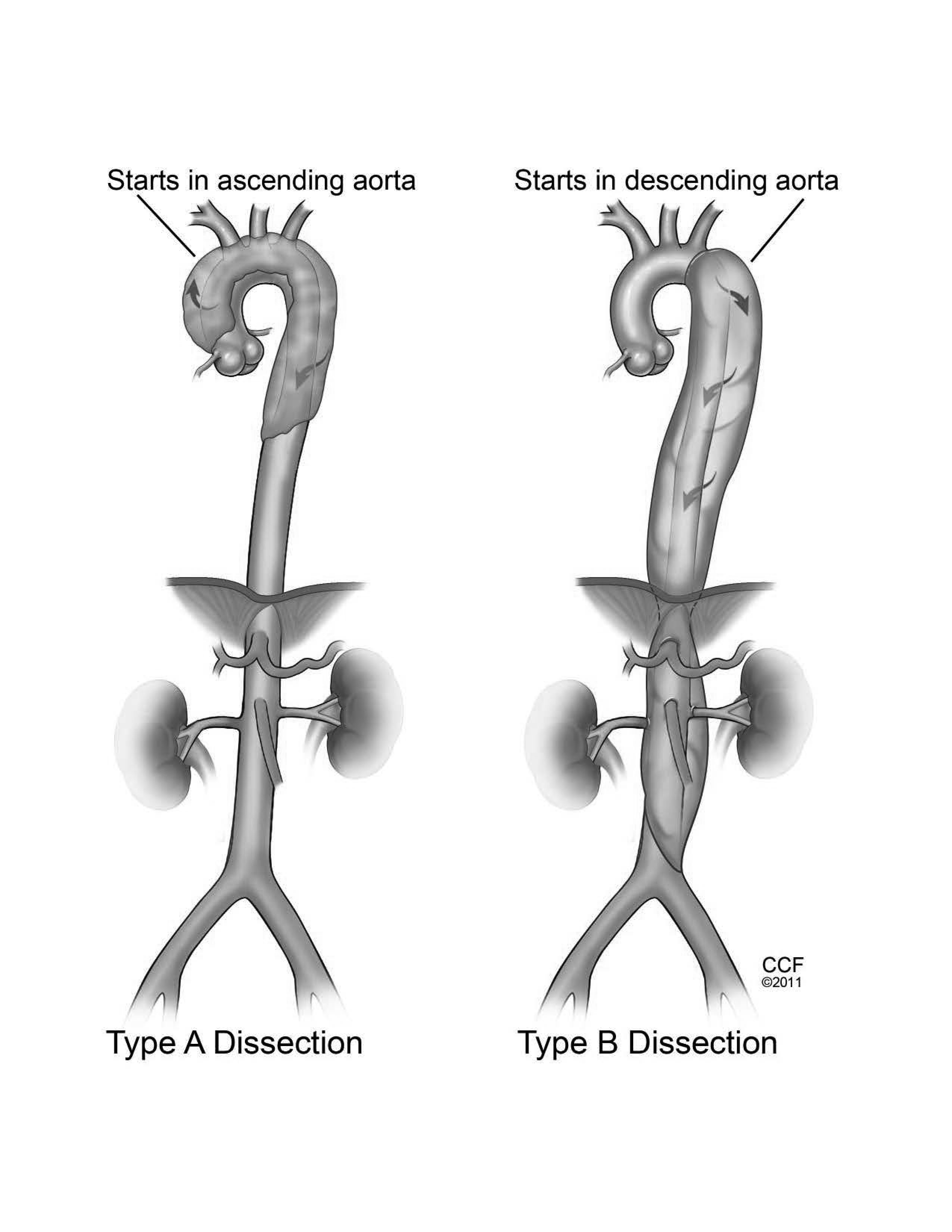 Aortic dissection types