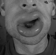 angioedema of the lips