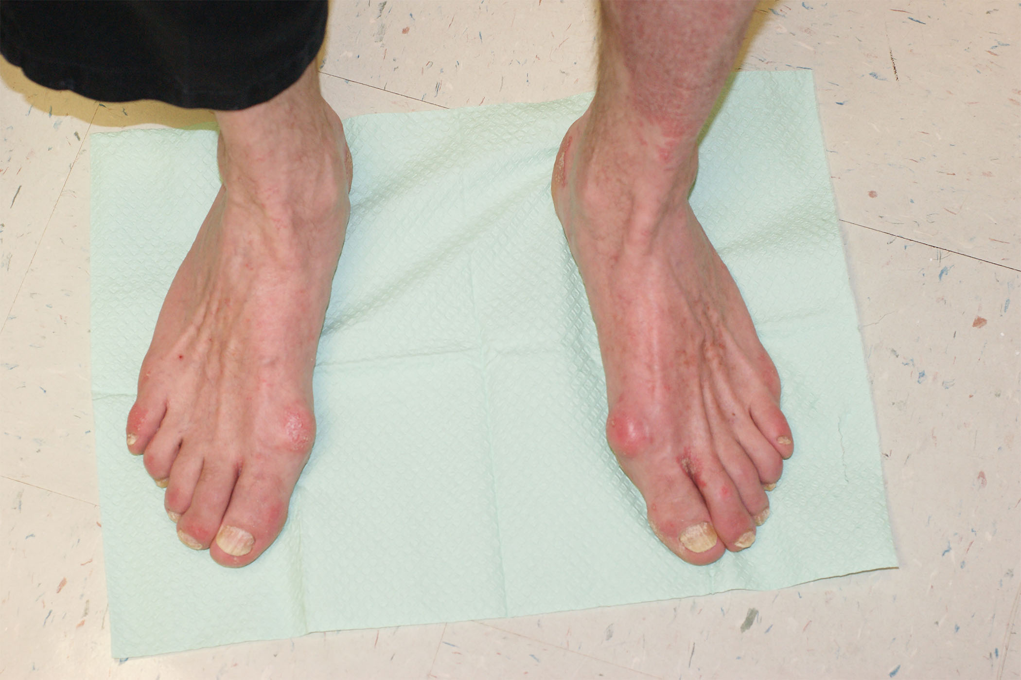 foot neuropathy
