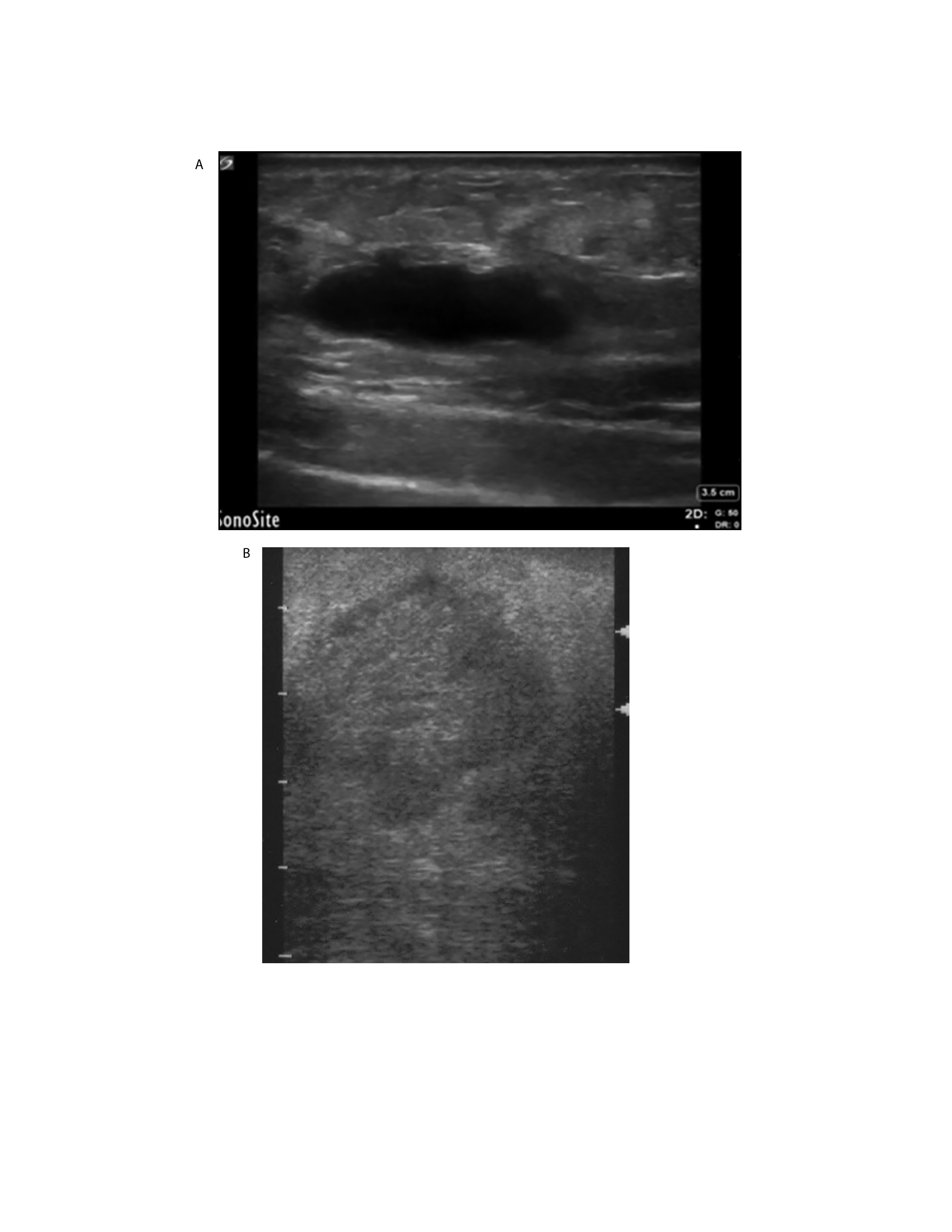ultrasound appearance of cutaneous abscesses