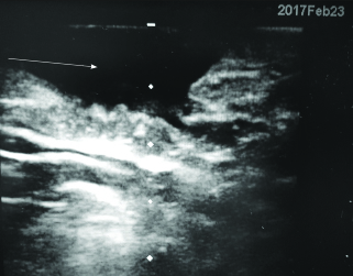 subcutaneous abscess ultrasound