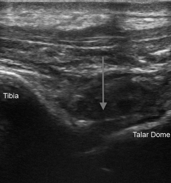 Ankle ultrasound
