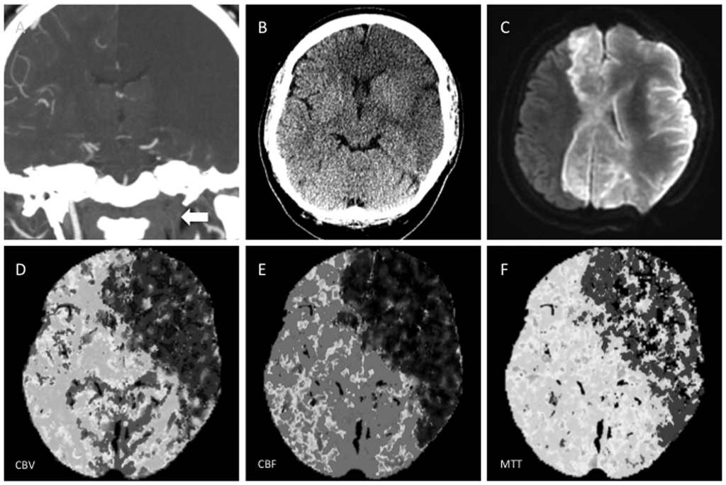 Large Core Infarction on CT Perfusion