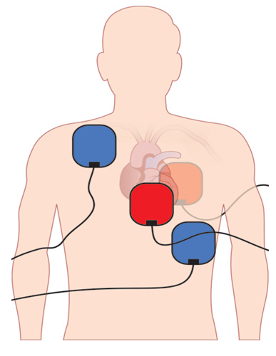 Double sequential defibrillation pad placement