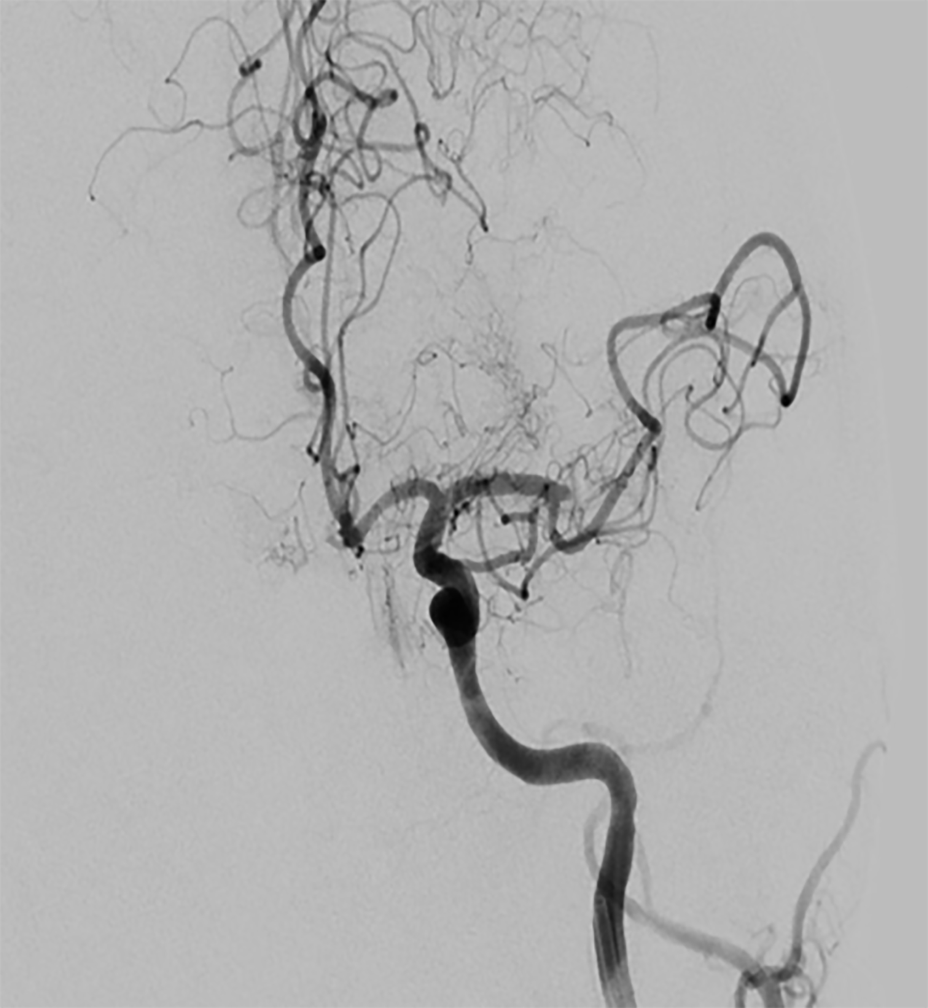 Occlusion of left middle cerebral artery