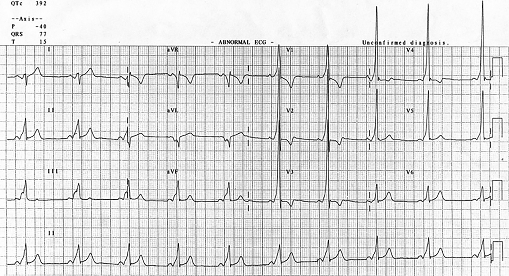 Wolff-Parkinson-White syndrome