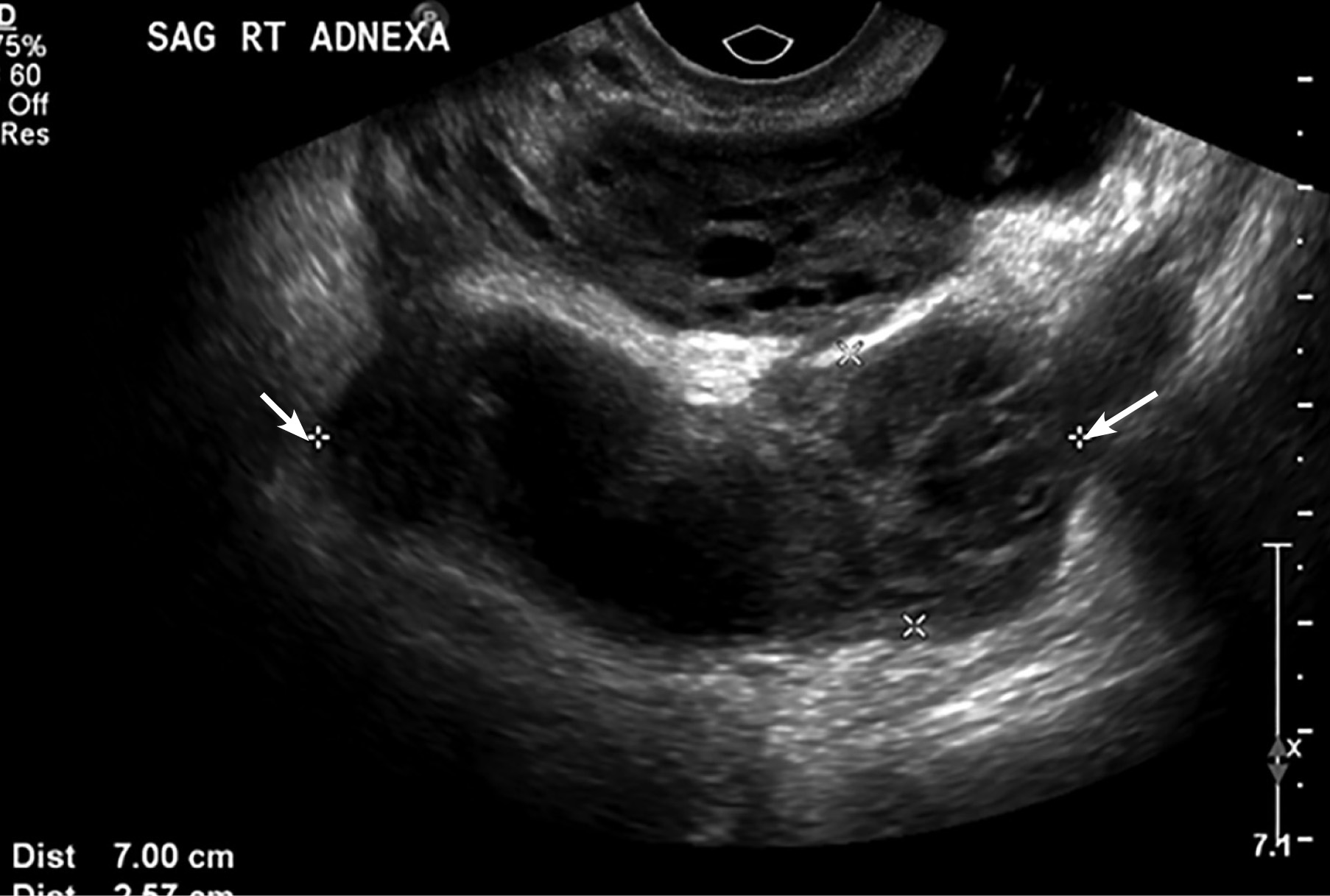 Ultrasound of right adnexa