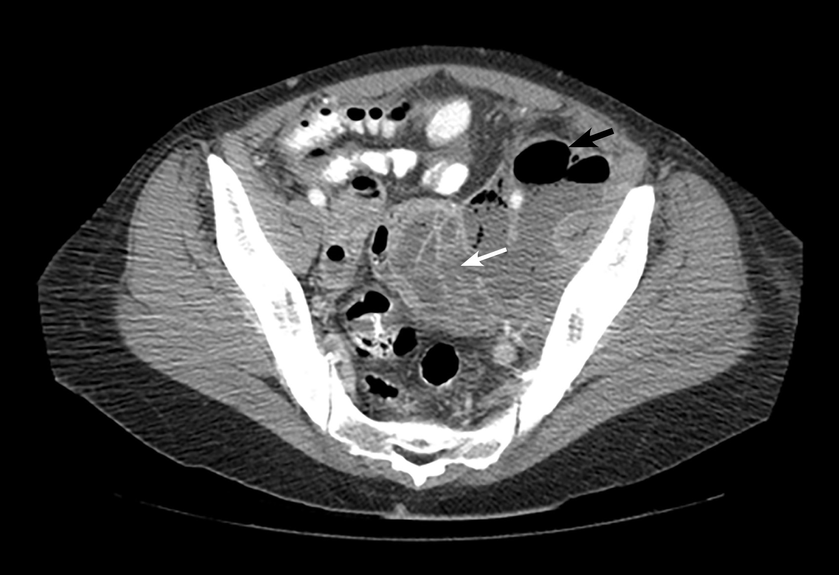 CT scan of pelvis