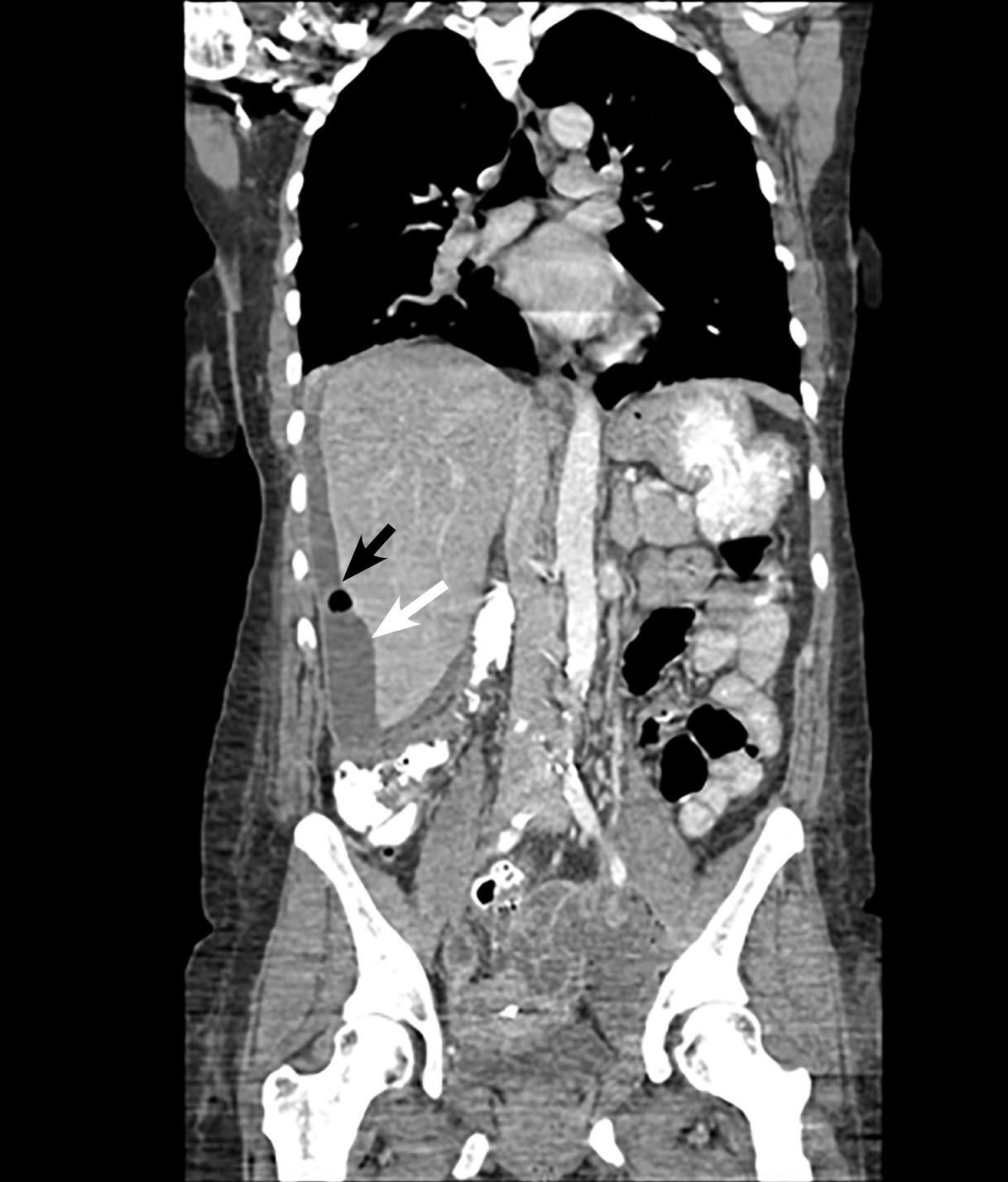 Coronal CT scan with left adnexal abscess