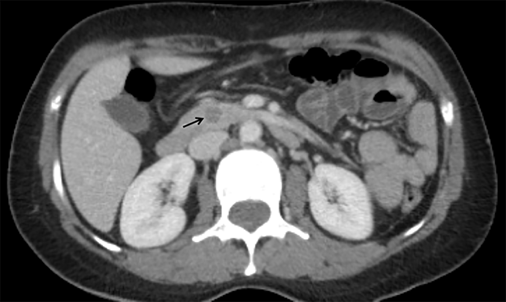 Computed Tomography Demonstrating Pancreatic Cancer