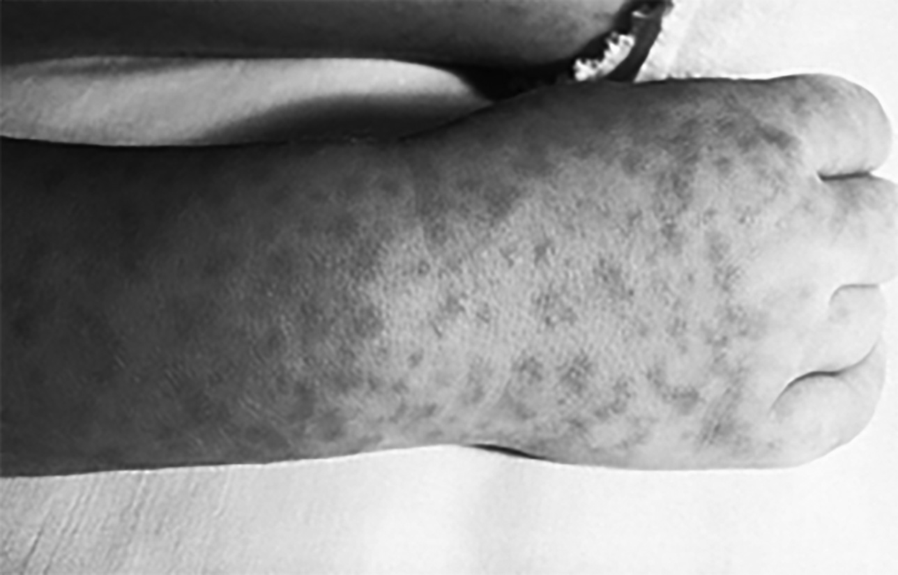 Rocky Mountain spotted fever rash