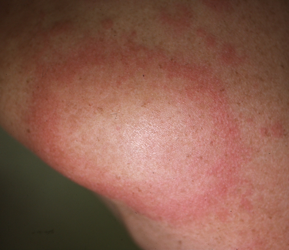 How Common Is Discoid Eczema? – Balmonds