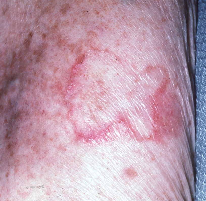 Not All Round Rashes Are Ringworm A Differential Diagnosis Of 2022