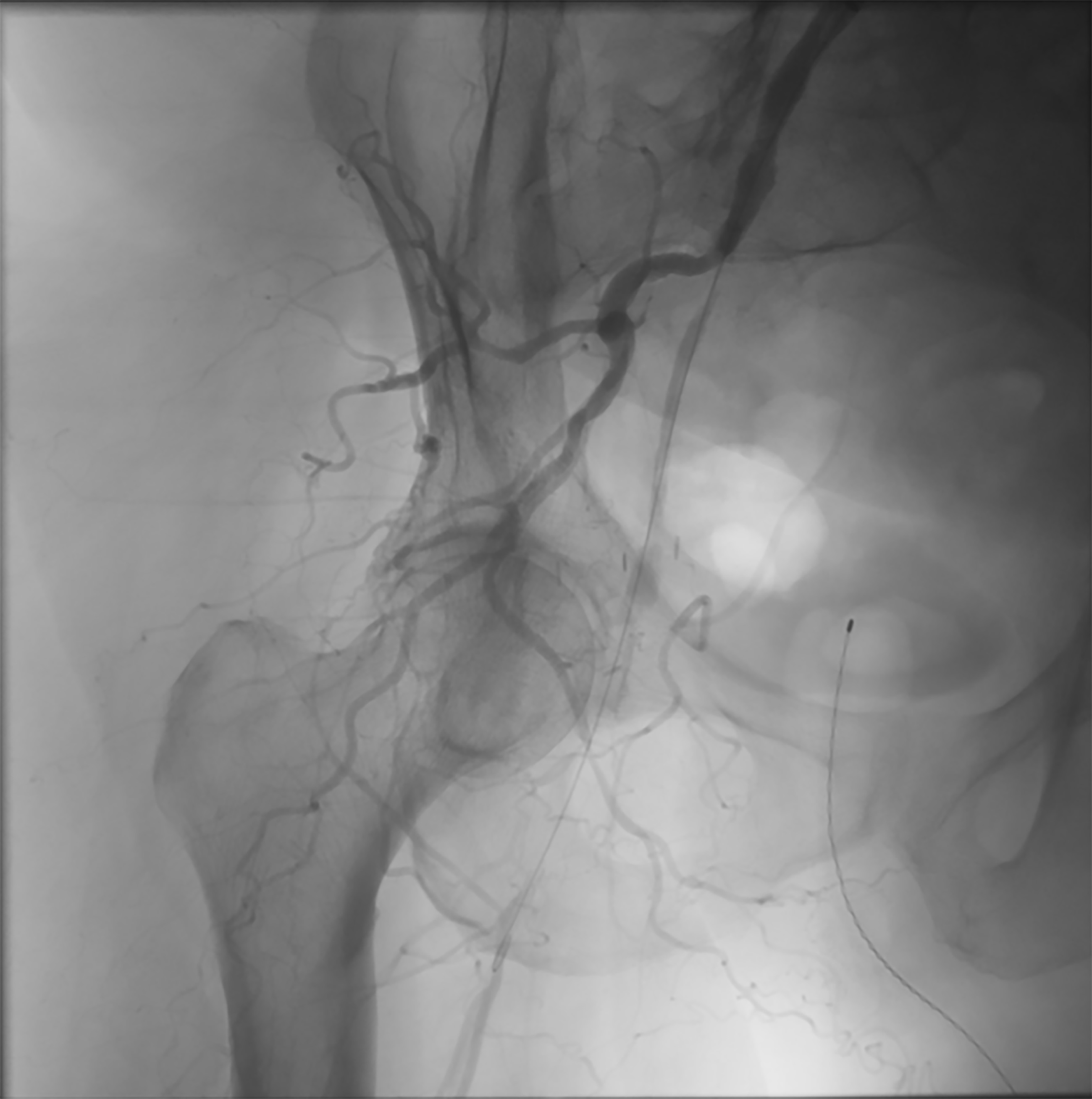 Occlusion of external iliac artery