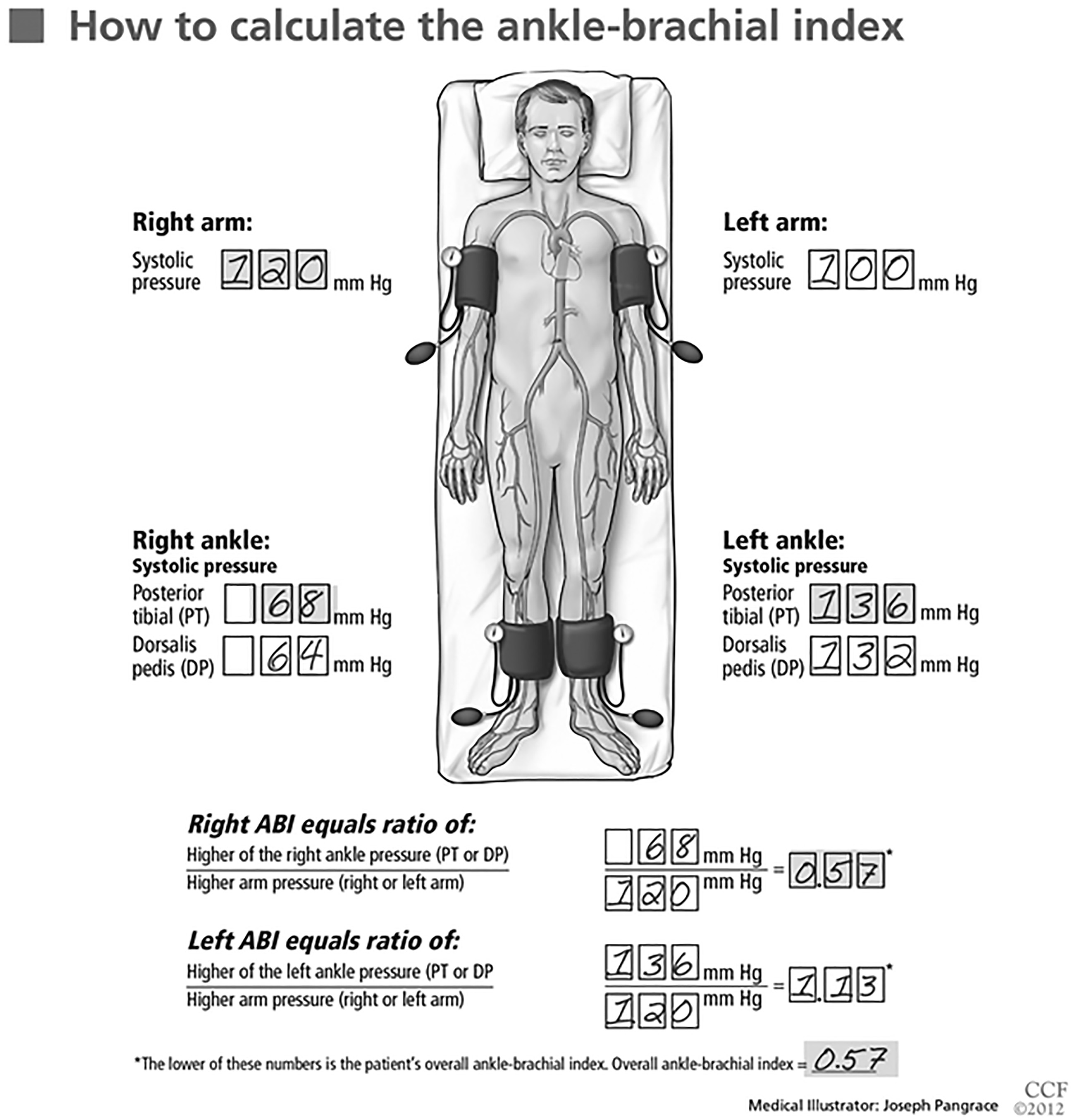 Calculation of ankle-brachial index