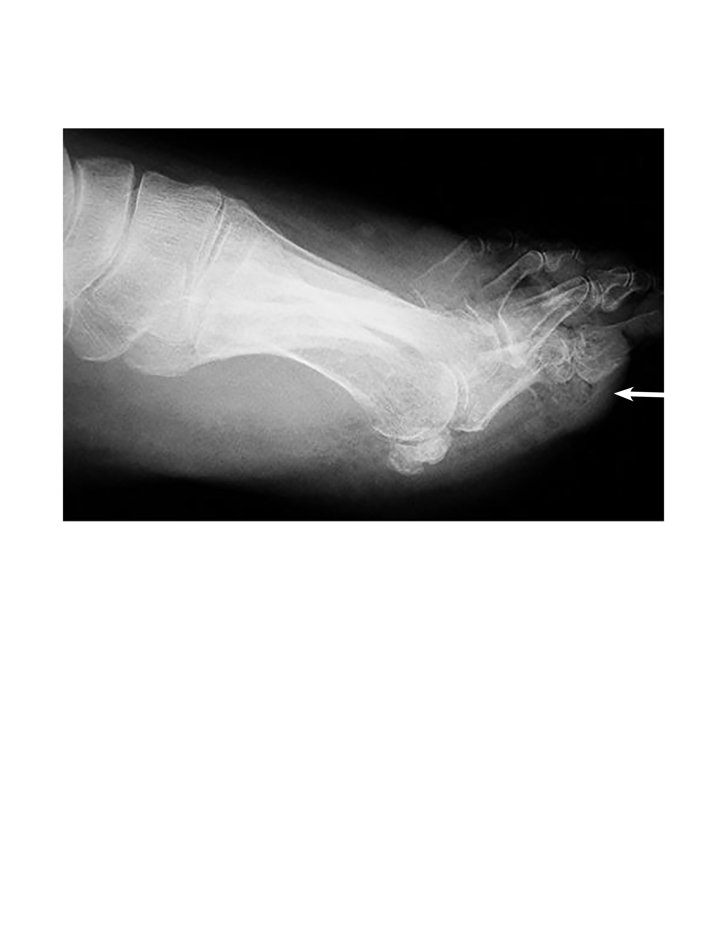 Radiograph of foot