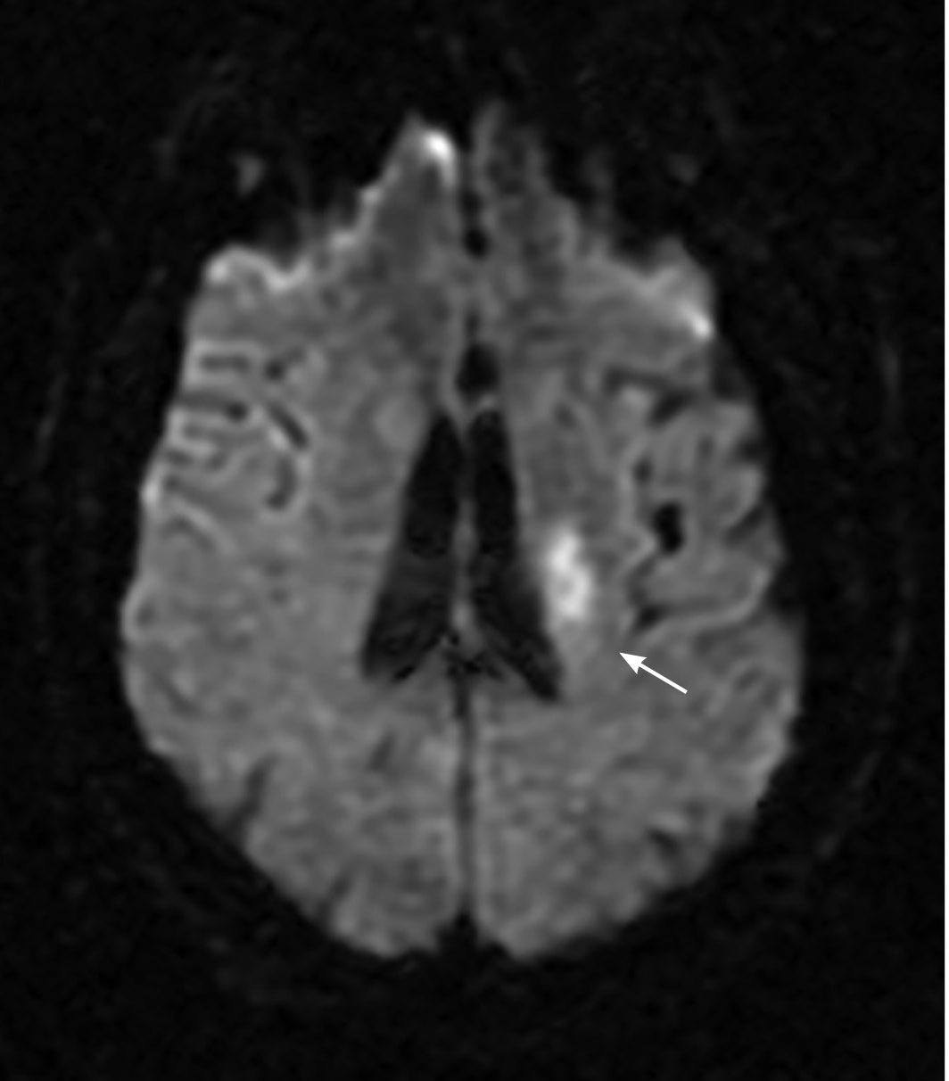 MRI DWI of an acute infarct