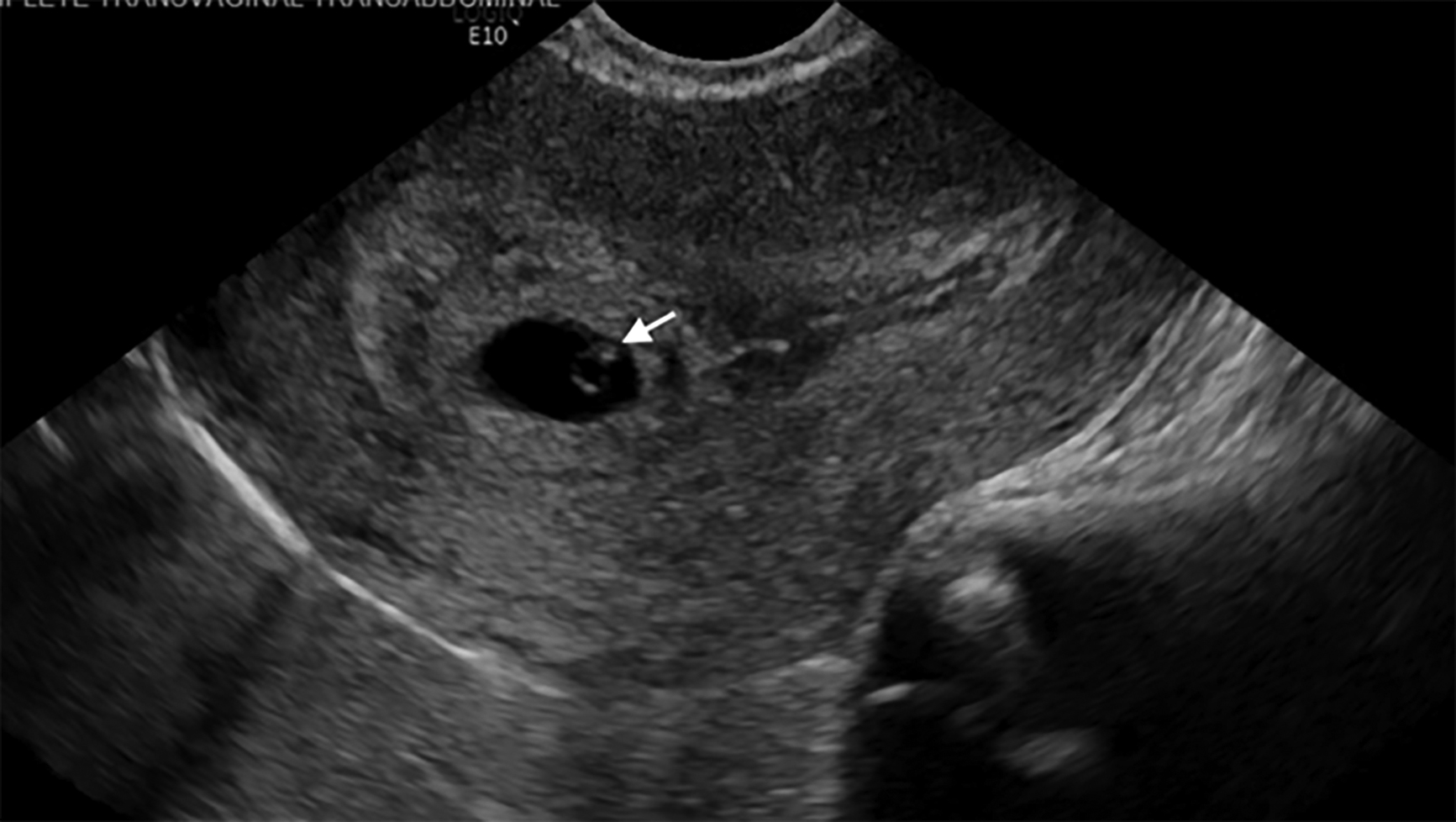 Intrauterine gestational sac with a yolk sac