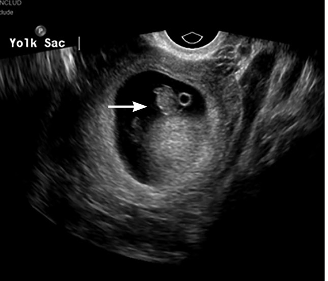 Intrauterine pregnancy