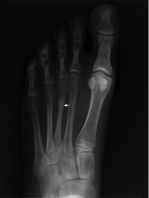 Stress fracture
