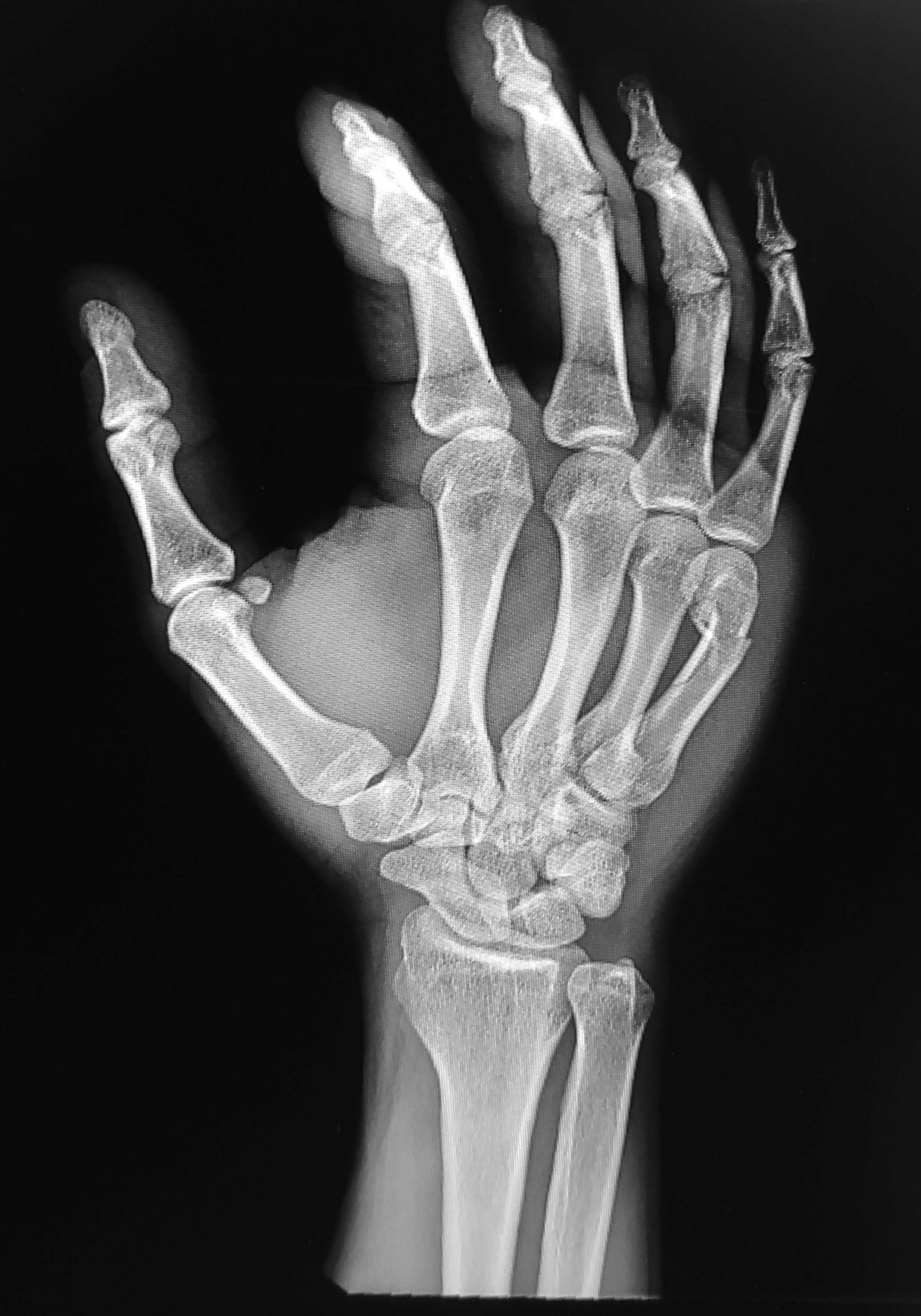 Boxer's fracture