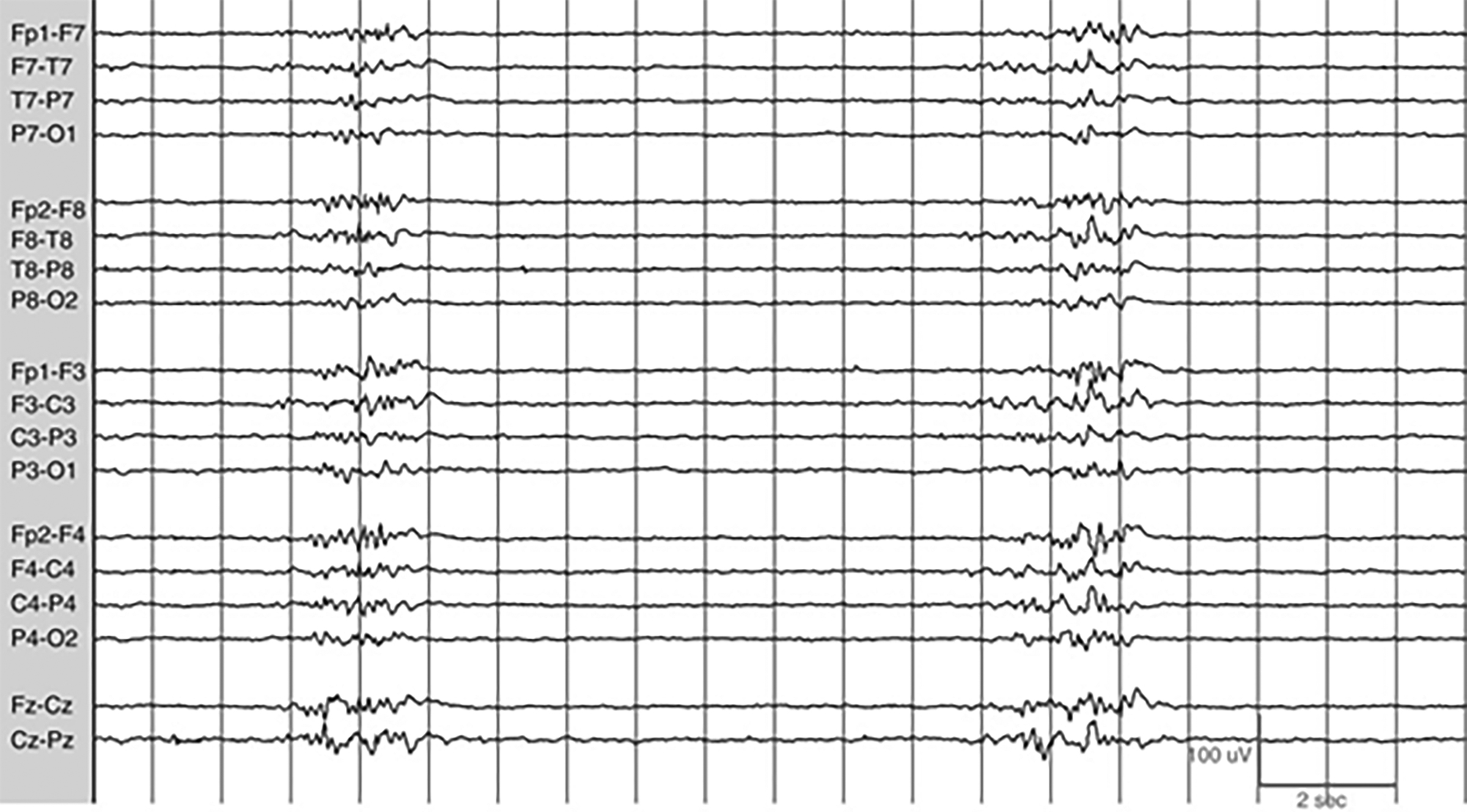 Burst suppression EEG