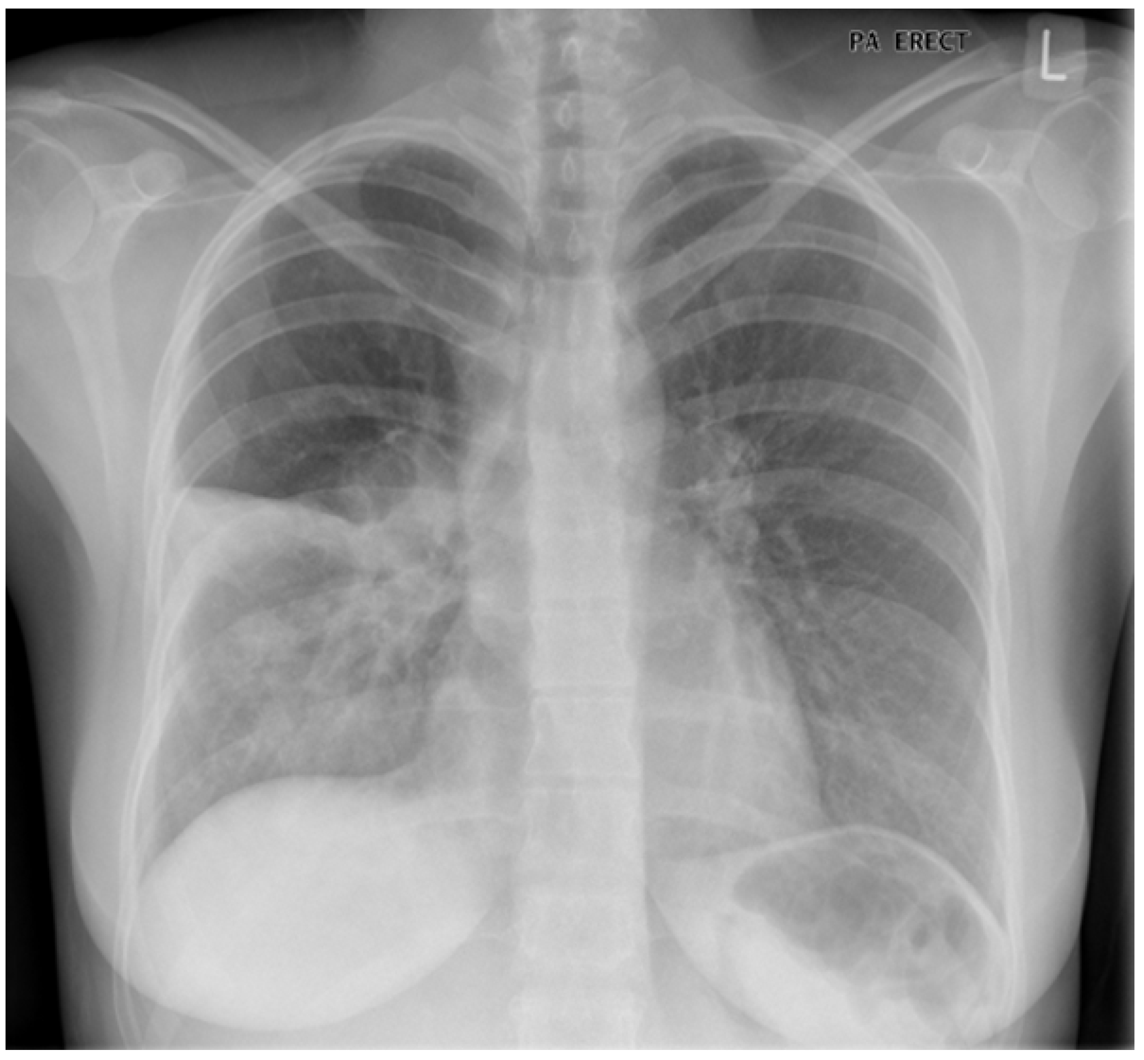 COPD Chest X-Ray