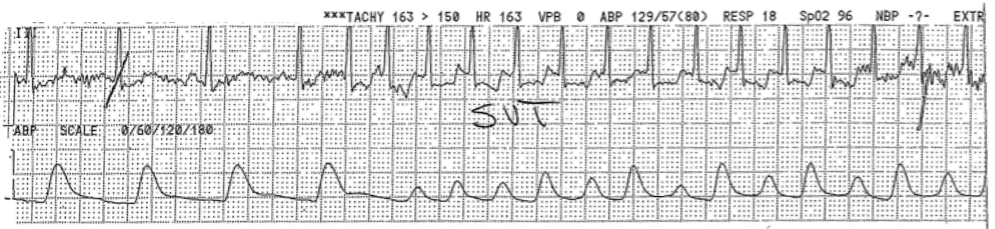 SVT as a cause of syncope